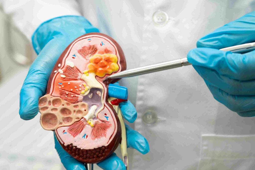 The 9 Unexpected Stages of Passing a Kidney Stone; #5 Will Shock You 3 Stages of passing a kidney stone